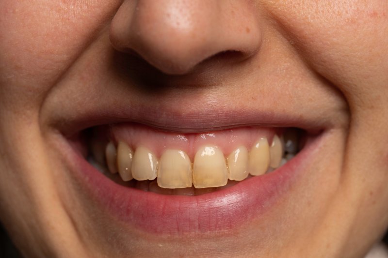 A close-up of a person with bad teeth